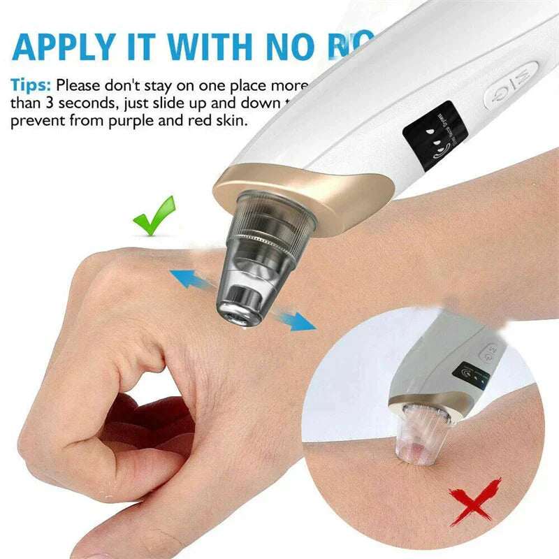 5-In-1 Rechargeable Suction Acne and Blackhead Remover for Men and Women