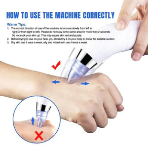 5-In-1 Rechargeable Suction Acne and Blackhead Remover for Men and Women