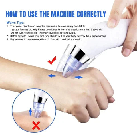 5-In-1 Rechargeable Suction Acne and Blackhead Remover for Men and Women